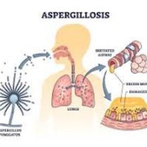 Aspergillosis - Dawn M. Aycock APRN-C